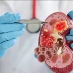 किडनी स्टोन को नजरअंदाज करना पड़ सकता है भारी, समय पर इलाज जरूरी